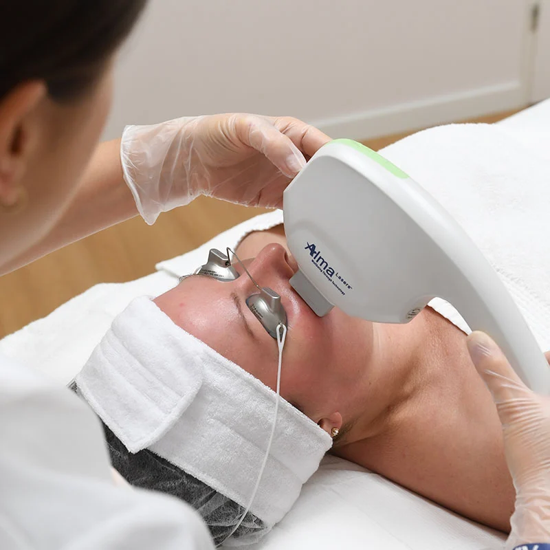 IPL-behandeling met de Harmony XL Pro