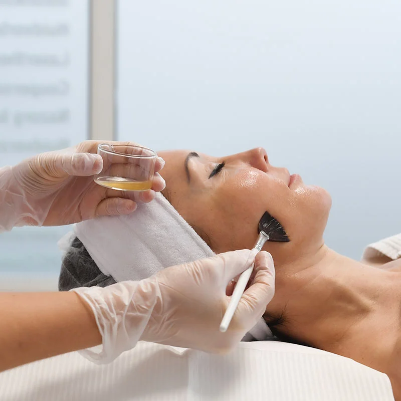 Medische peeling tegen pigmentvlekken