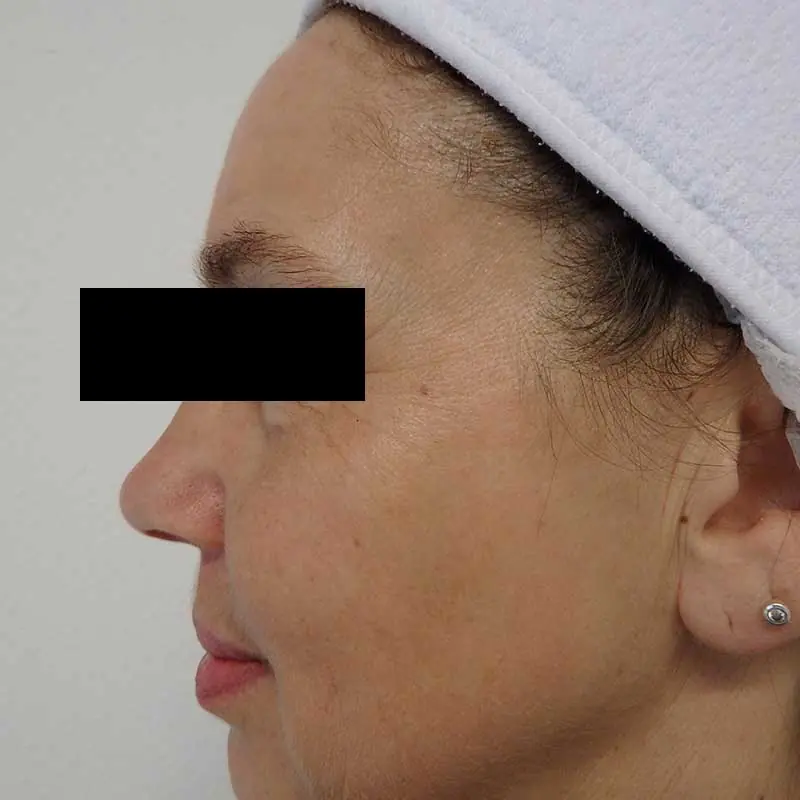 Dezelfde wang na de behandeling, met minder pigment