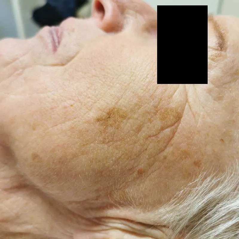 Gezicht met pigment vóór de behandeling